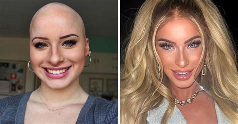 chloe bean naked|A Girl Who Suffered Greatly From Alopecia Now Makes Profit Out .